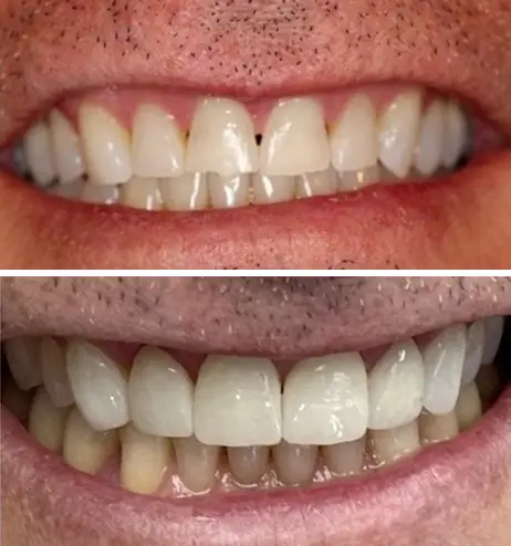 Yellow enamel and an uneven smile line - Straight teeth and a bright white smile
