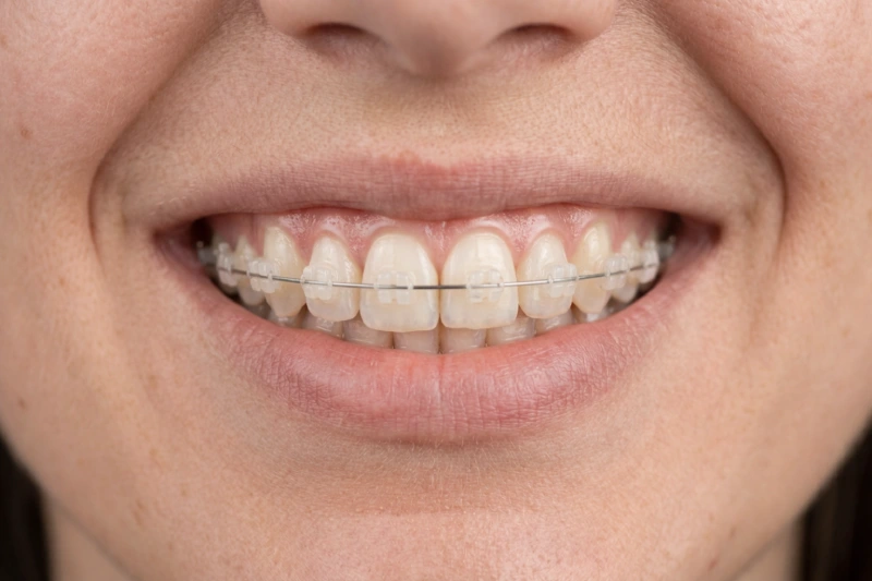 ceramic braces on teeth