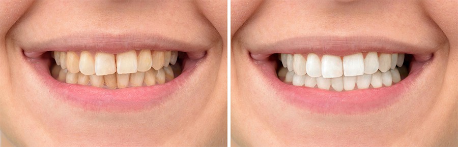 teeth-whitening-1