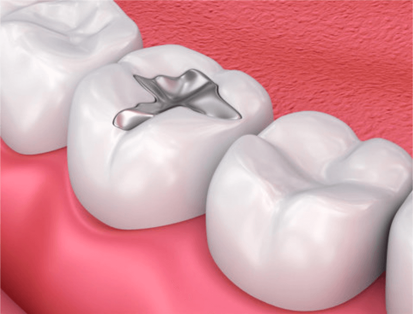 Advanced Dental Wellness of Ft Lauderdale -dental filling mercury removal