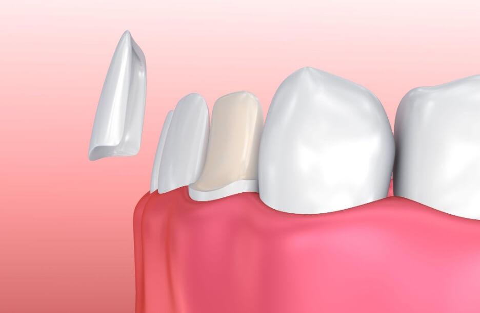 3 Best Types of Veneers All You Need to Know