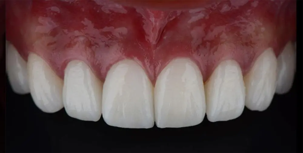Front teeth with porcelain veneers case 1 after