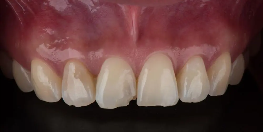 Front teeth with porcelain veneers case 1 before