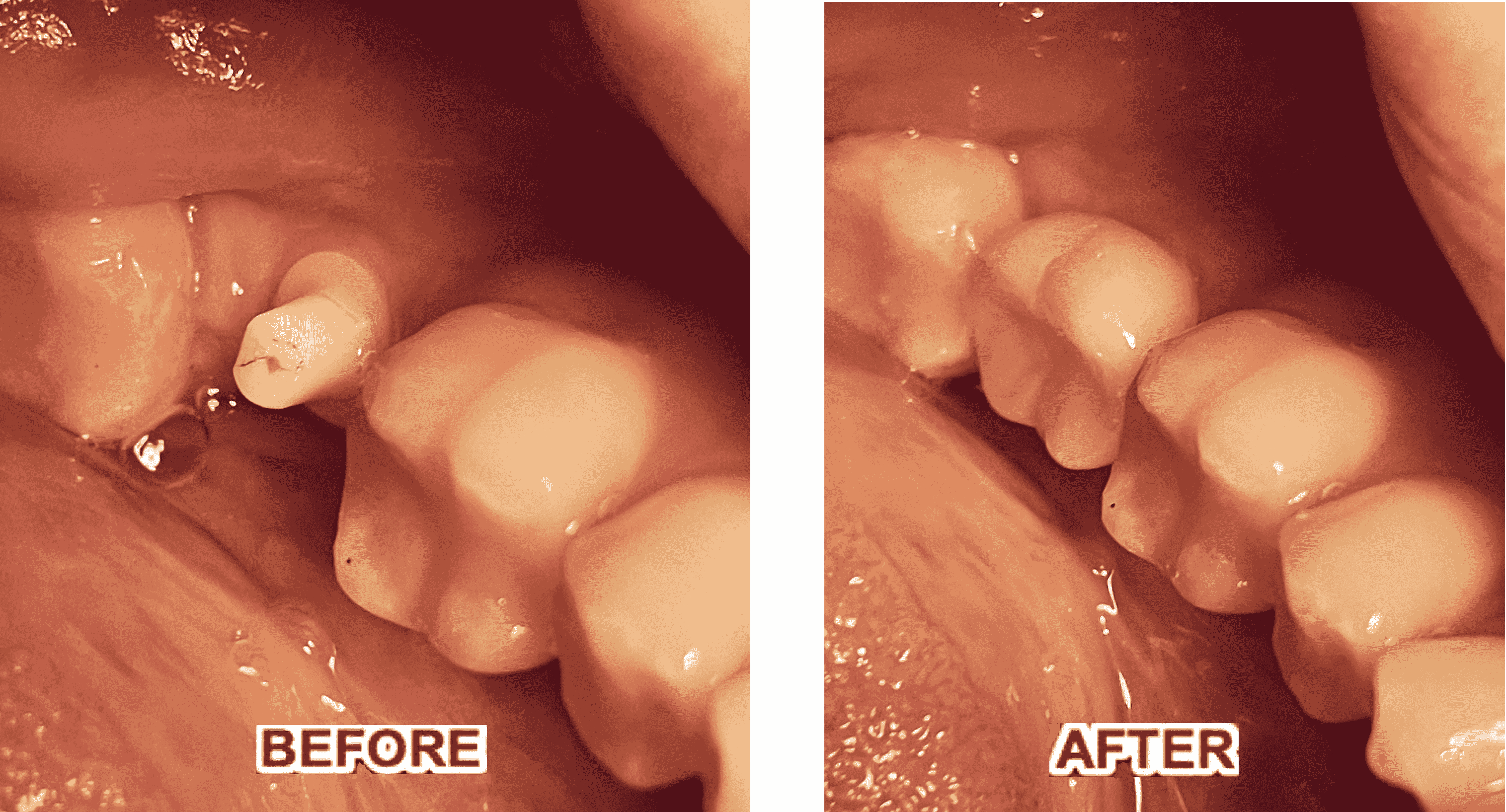 Zirconia implants: before and after ADW Center