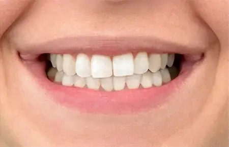 Teeth whitening case 1 after