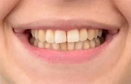 Teeth whitening case 1 before
