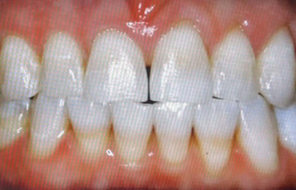 Teeth whitening case 2 after