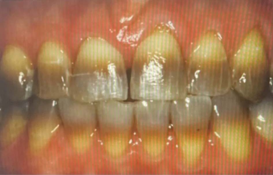 Teeth whitening case 2 before