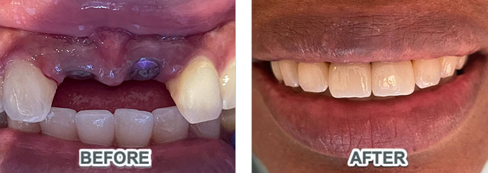 The patient restored his beautiful and healthy smile