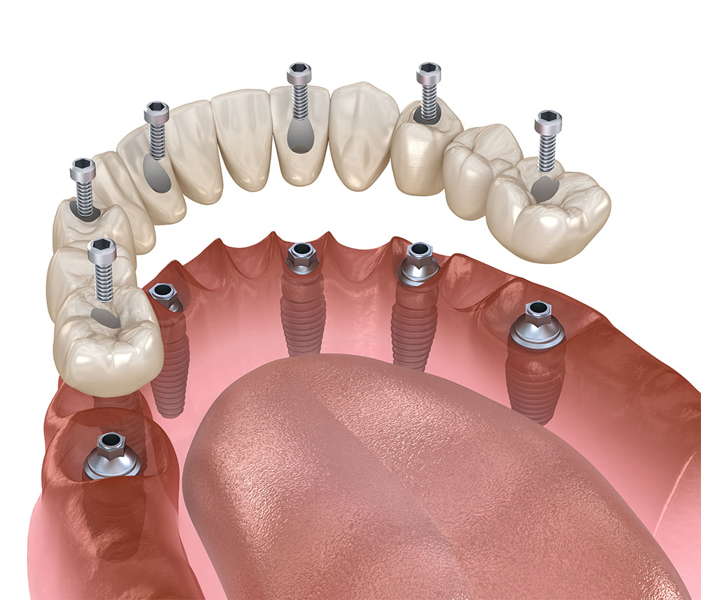 all-on-6 dental implants