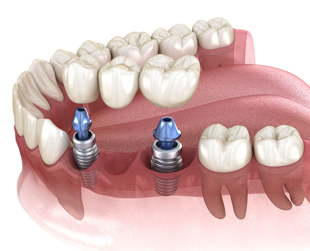 multiple tooth implantation