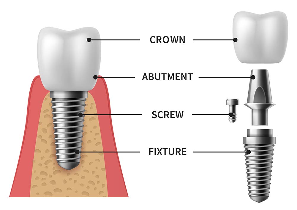 Dental Implants structure