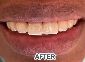 dental implants case 1 after