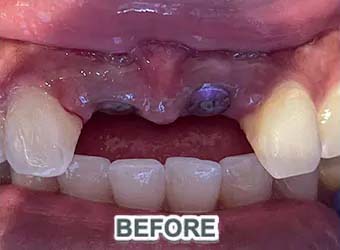 dental implants case 1 before