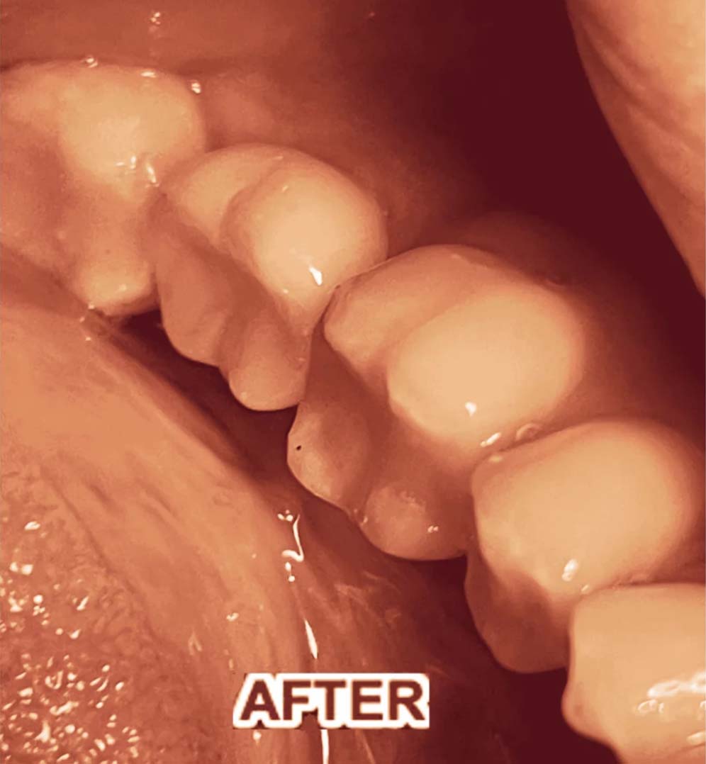 dental implants case 2 after