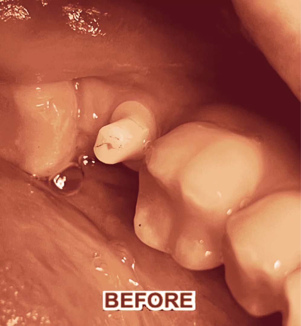 dental implants case 2 before