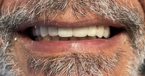 dental implants case 3 after
