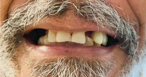 dental implants case 3 before