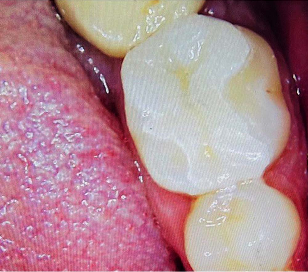 Dental onlay to molar