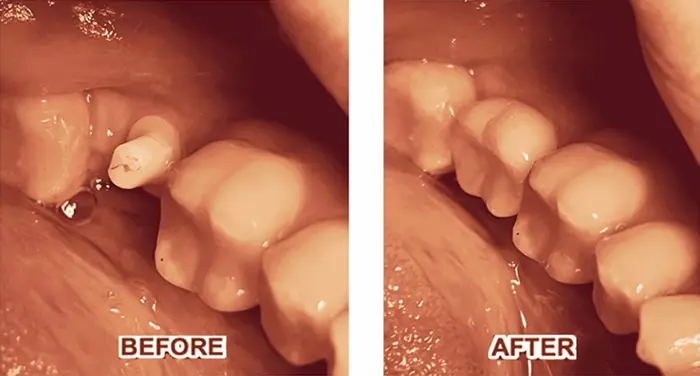dental implants case 4