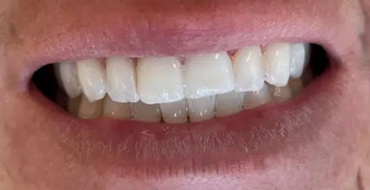 Irregular teeth