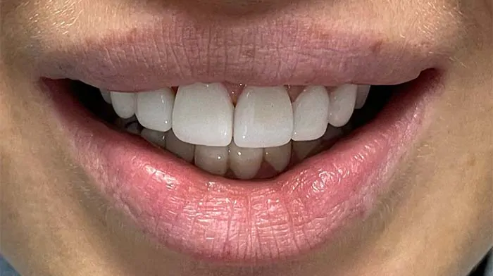 New smile after dental veneers placement