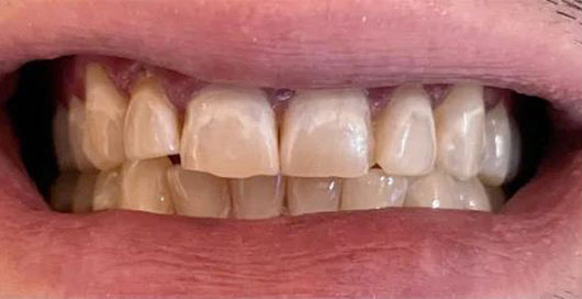 Teeth before veneers