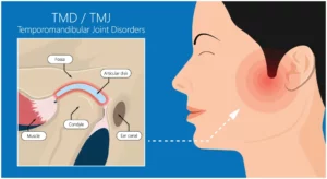 Temporomandibular Joint Disorders TMD TMJ