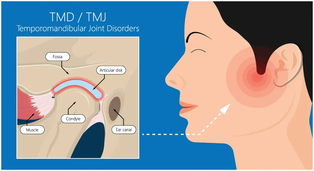 TMJ/TMD Treatments, Clicking or Popping Jaw Solutions in Lisle, IL