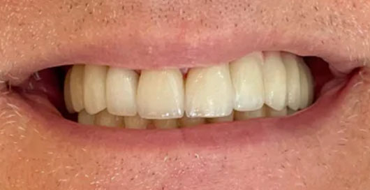 dental veneers on teeth