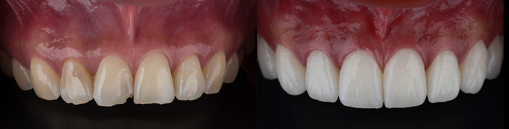 Porcelain veneers for front teeth