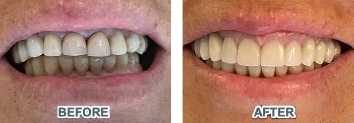 Dental crowns before & after