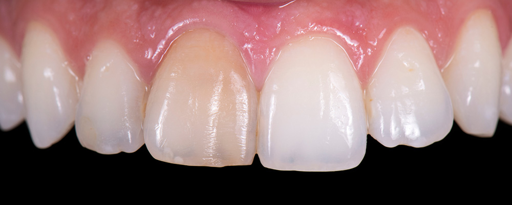 Front tooth discoloration