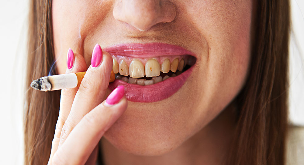 A woman with yellow stains on her teeth holding a cigarette