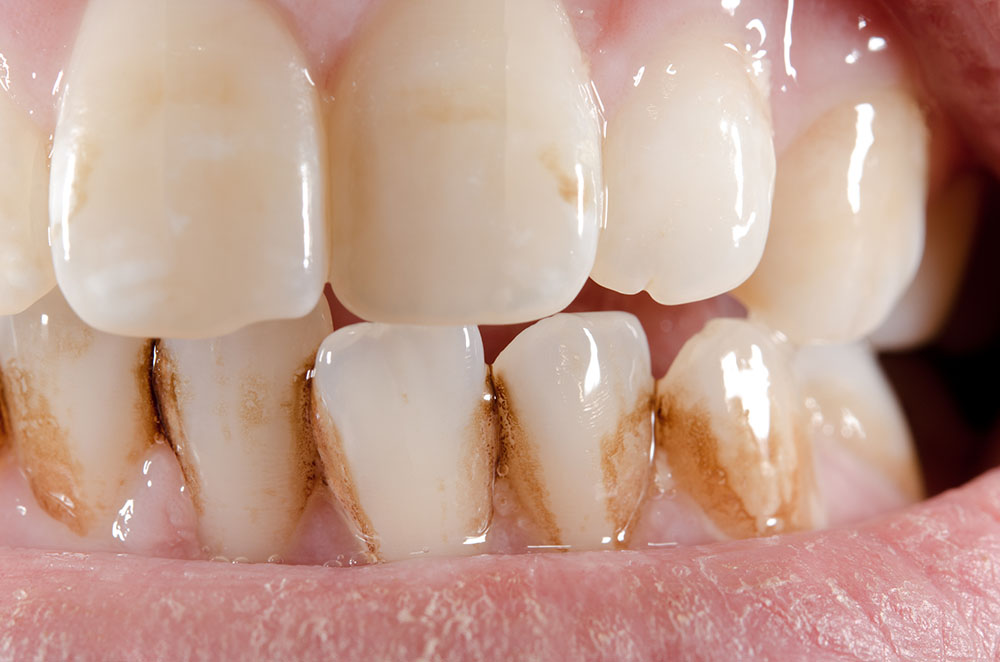 Stained teeth with tartar