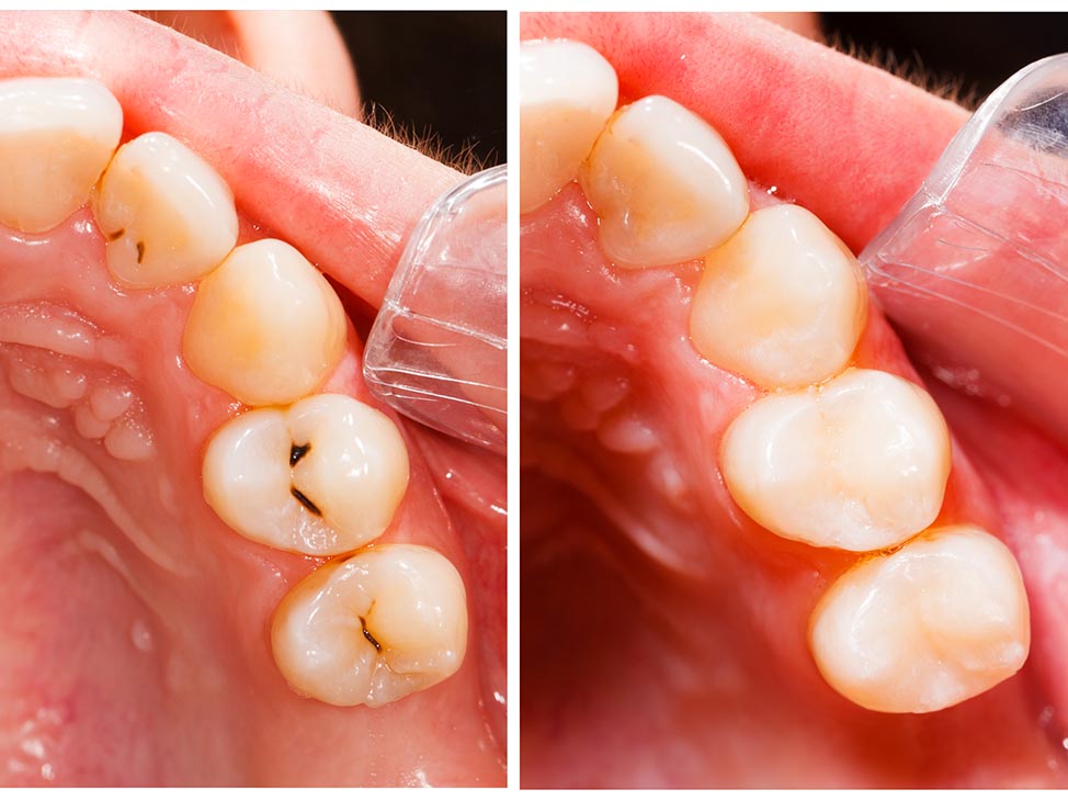 Tooth filling before and after