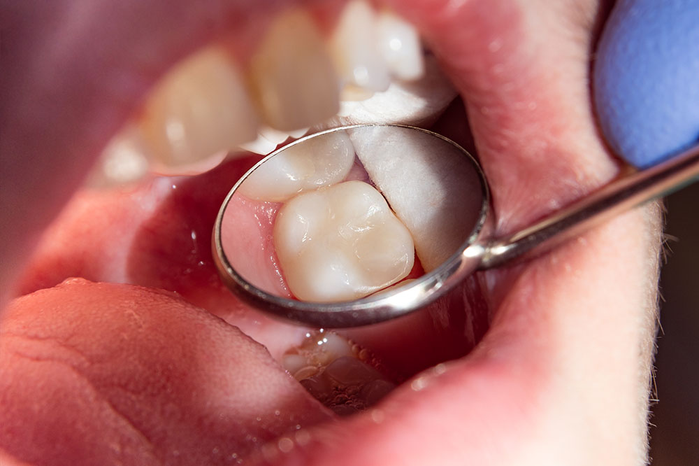 Composite filling between the cusps of the chewing tooth