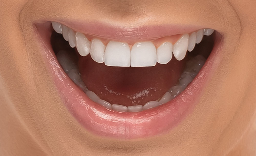 Composite fillings are invisible even up close