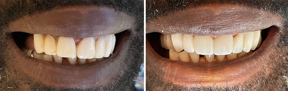 case removal partial denture