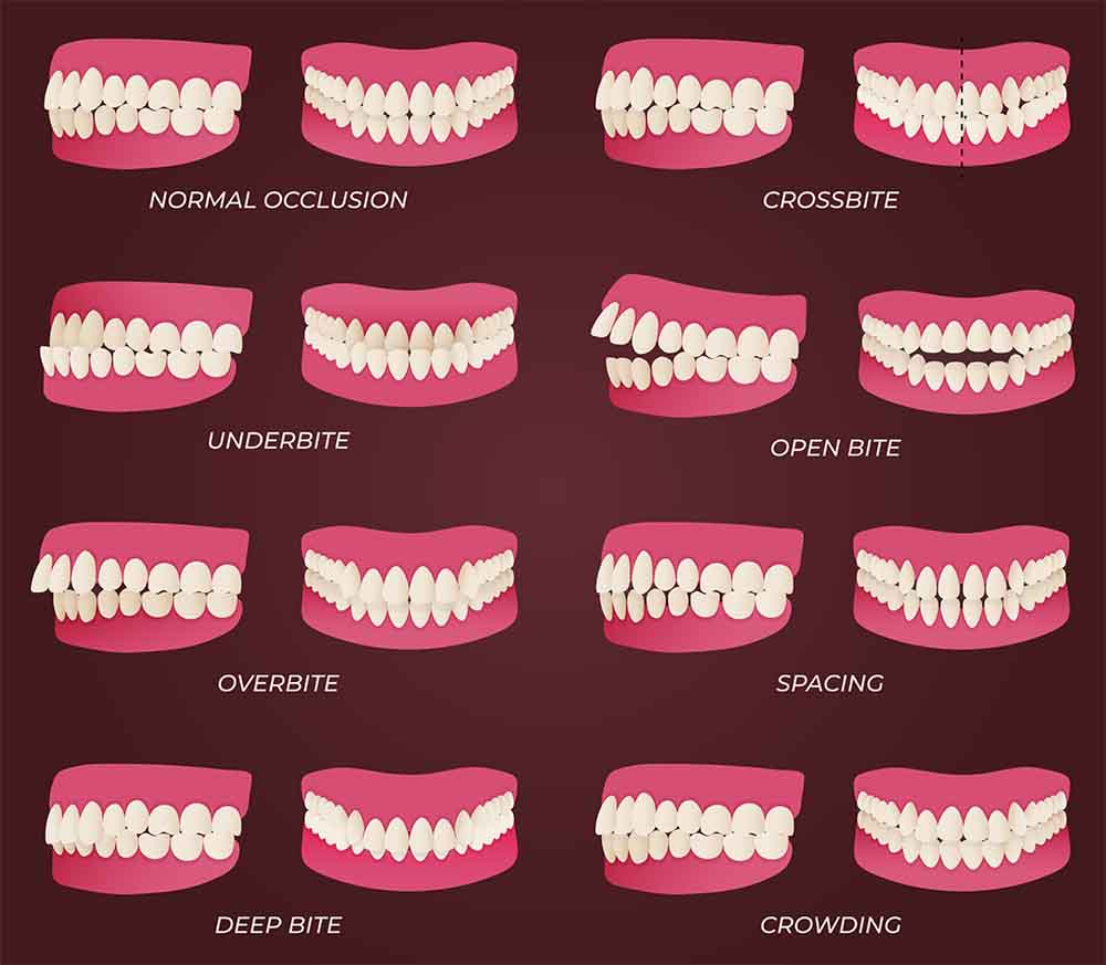 Crooked teeth types