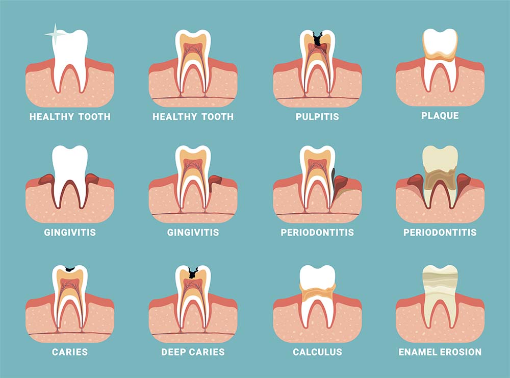 Tooth pain symptomatic