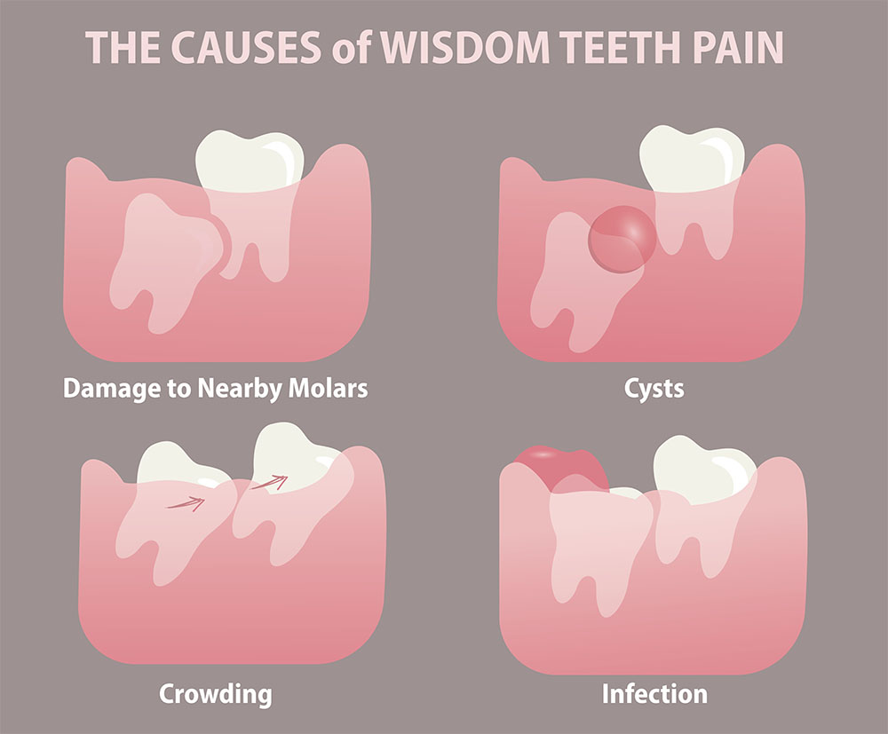 Wisdom tooth pain causes