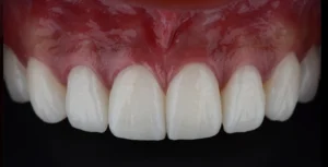 Ceramic veneers before and after placement
