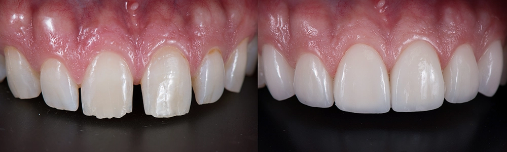 Correction teeth with porcelain veneers
