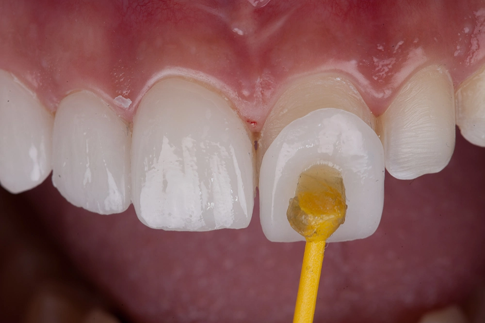 Veneers install of the front teeth