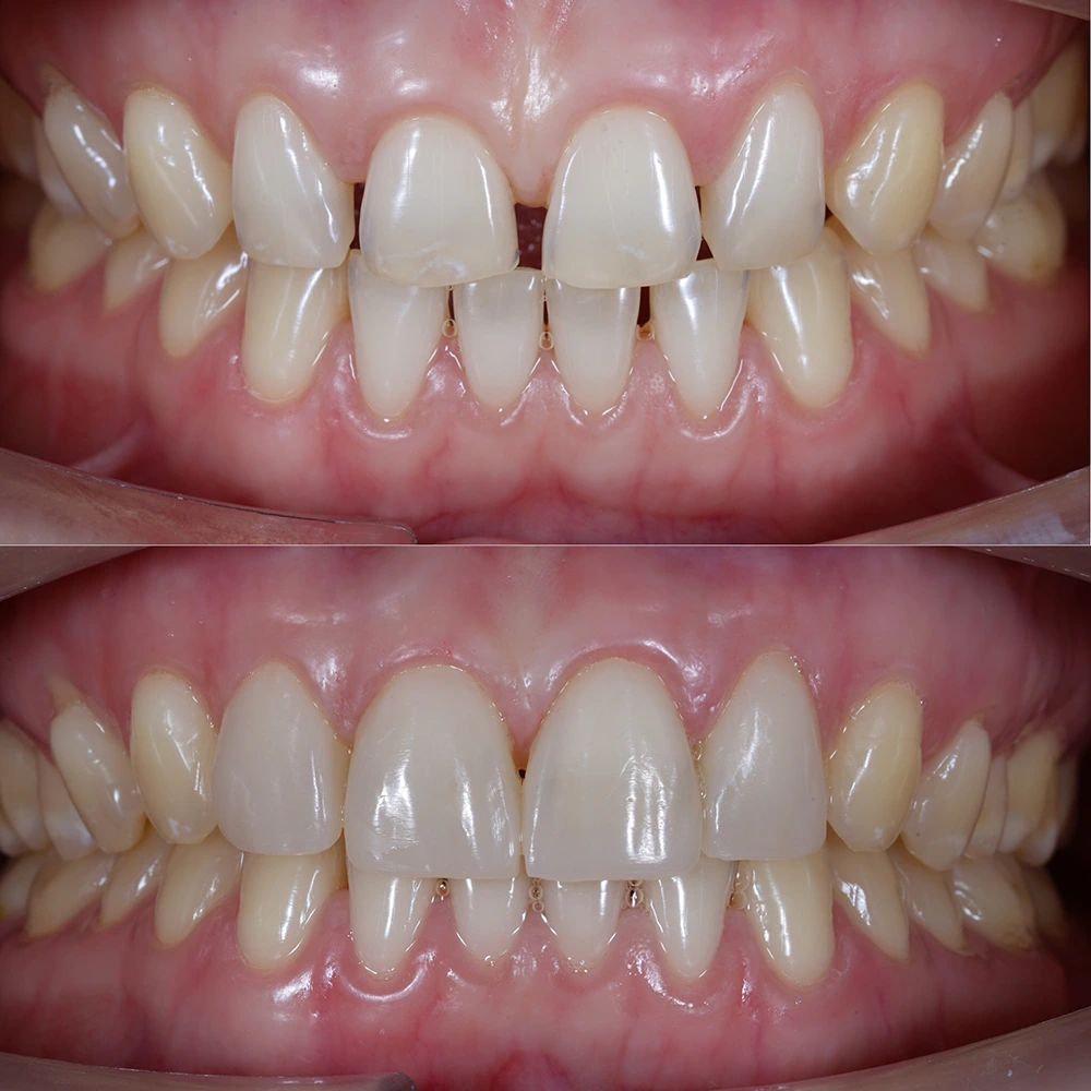 Before and after or composite veneers