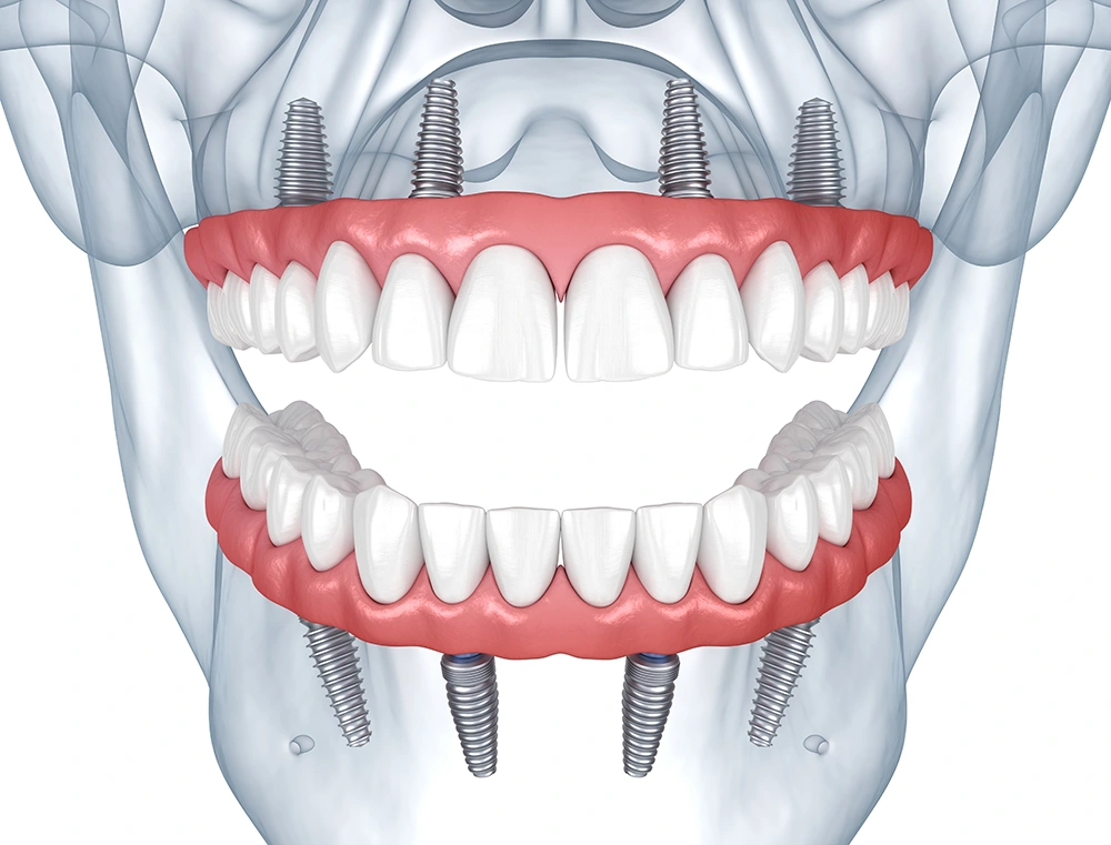 Implantation of teeth in a day using the All-on-4 method on the upper and lower jaw