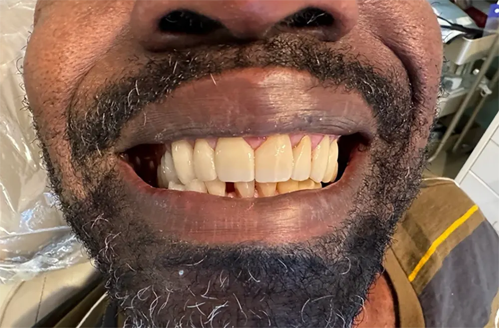 Man smiles with new teeth