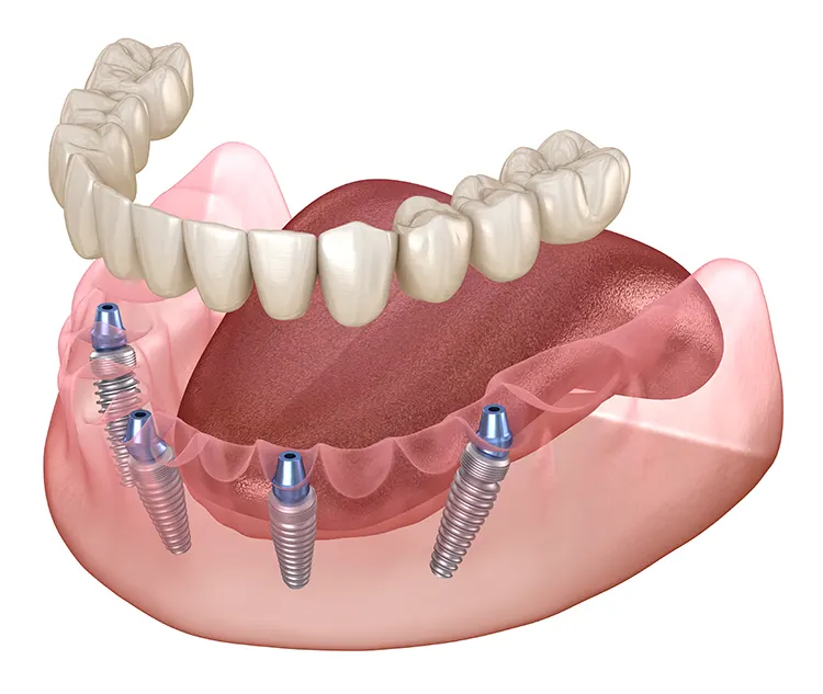 All-on-4 teeth implantation sheme