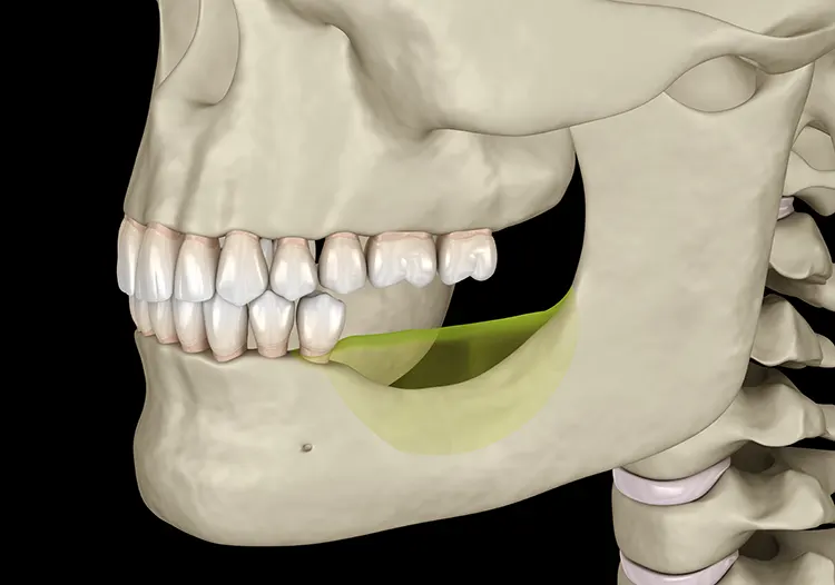 Atrophy of the jawbone in the area of lost chewing teeth